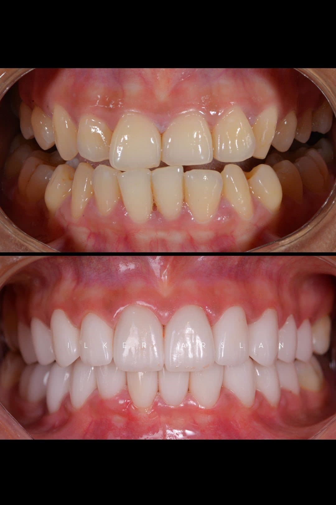 Blanchiment dentaire sourire naturel — Dr Tahri Agdal