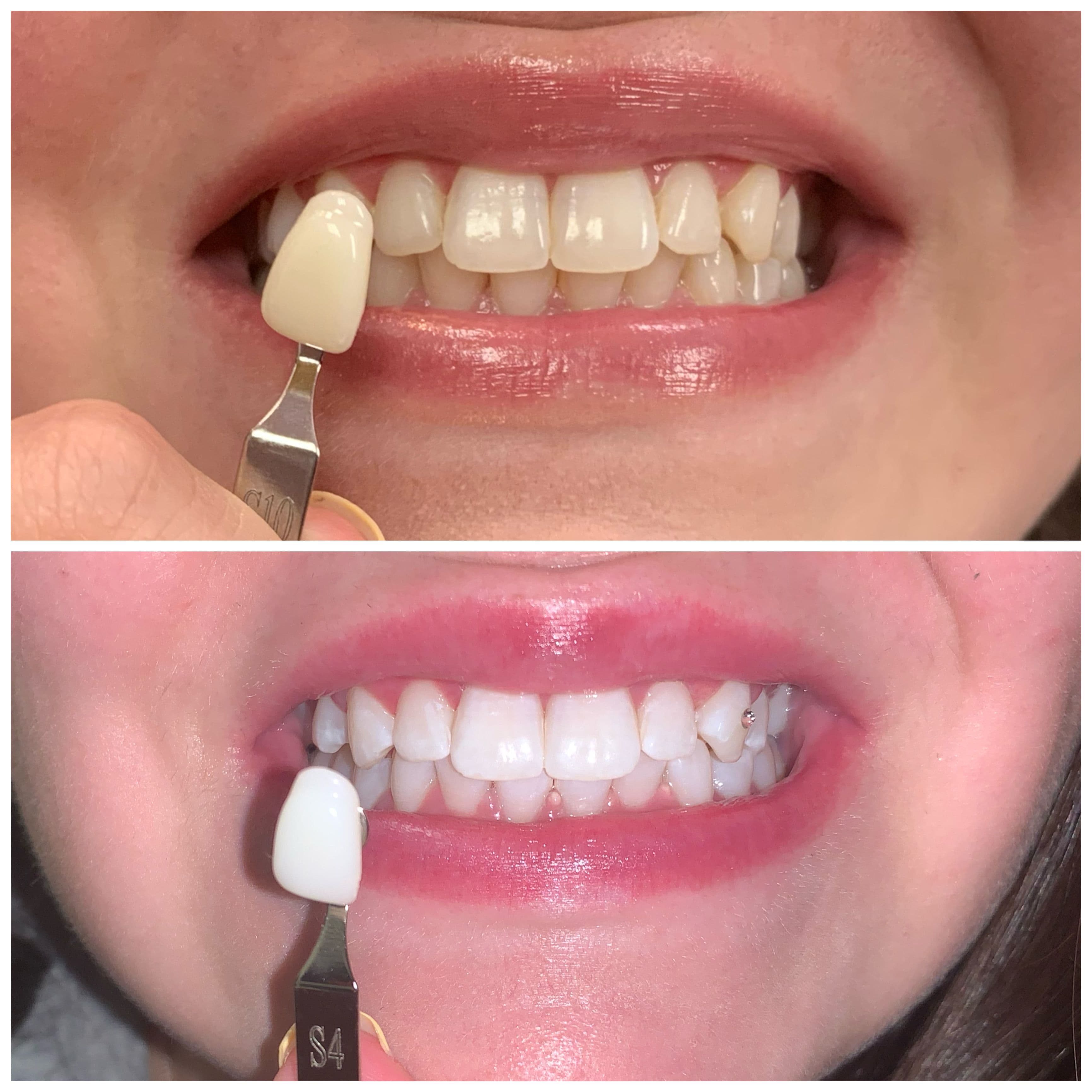 Traitement orthodontique bagues — Dr Tahri Rabat Agdal