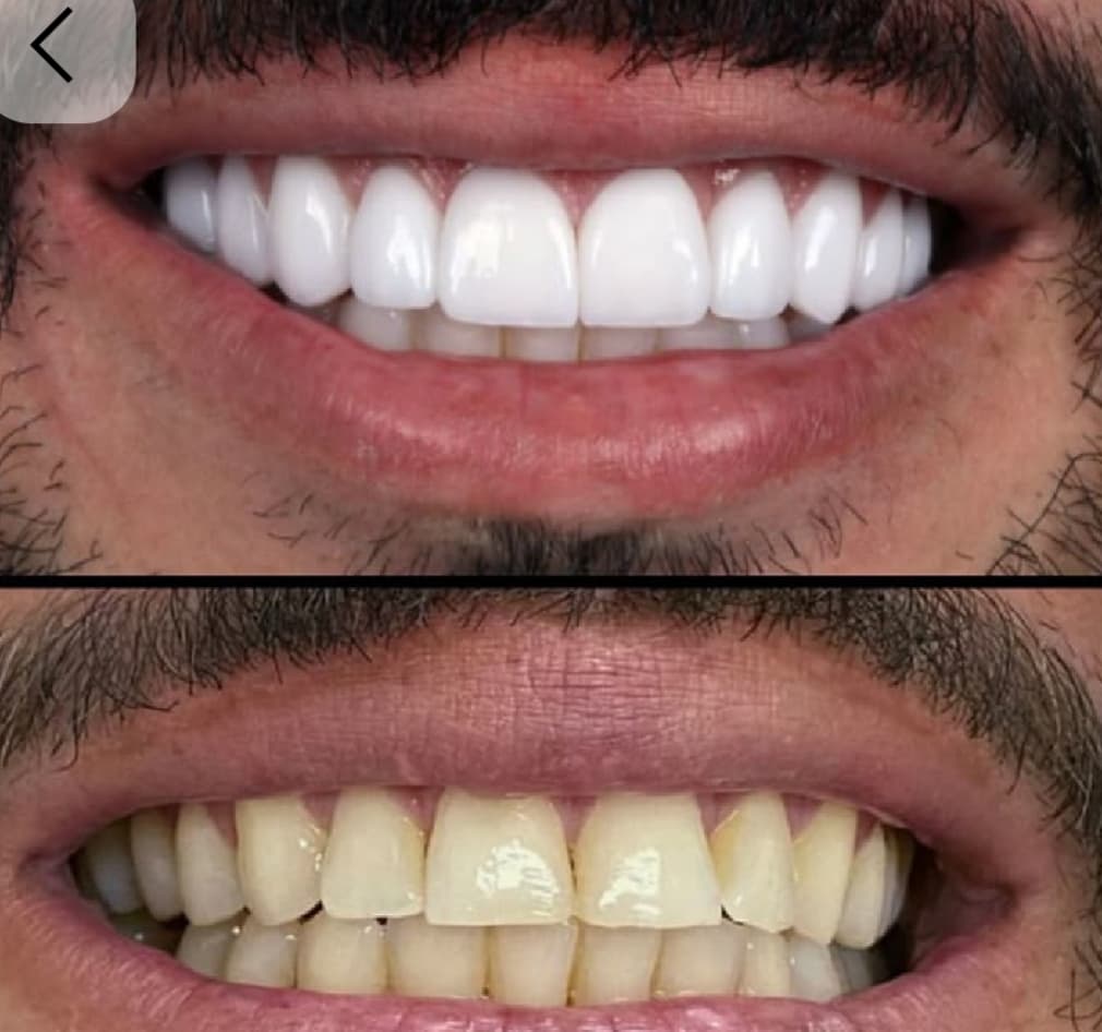 Blanchiment dents avant-après — Dr Tahri Rabat Agdal